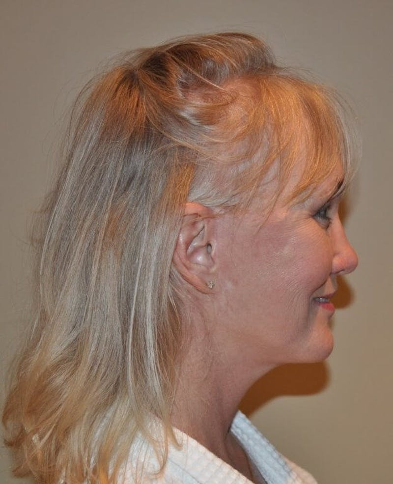 Face Lift Before & After Gallery - Patient 91514717 - Image 4