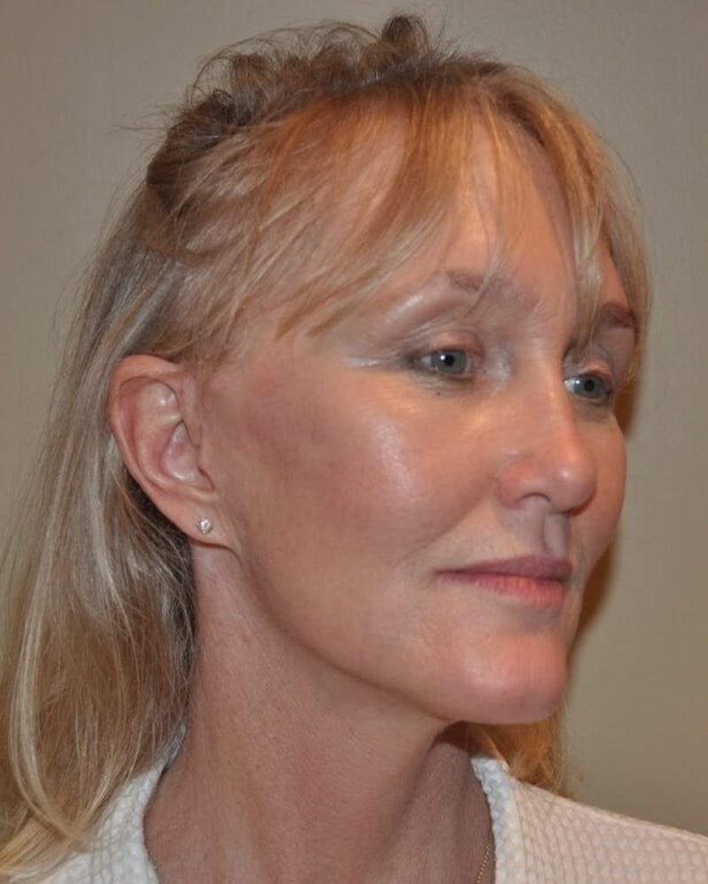Face Lift Before & After Gallery - Patient 91514717 - Image 2