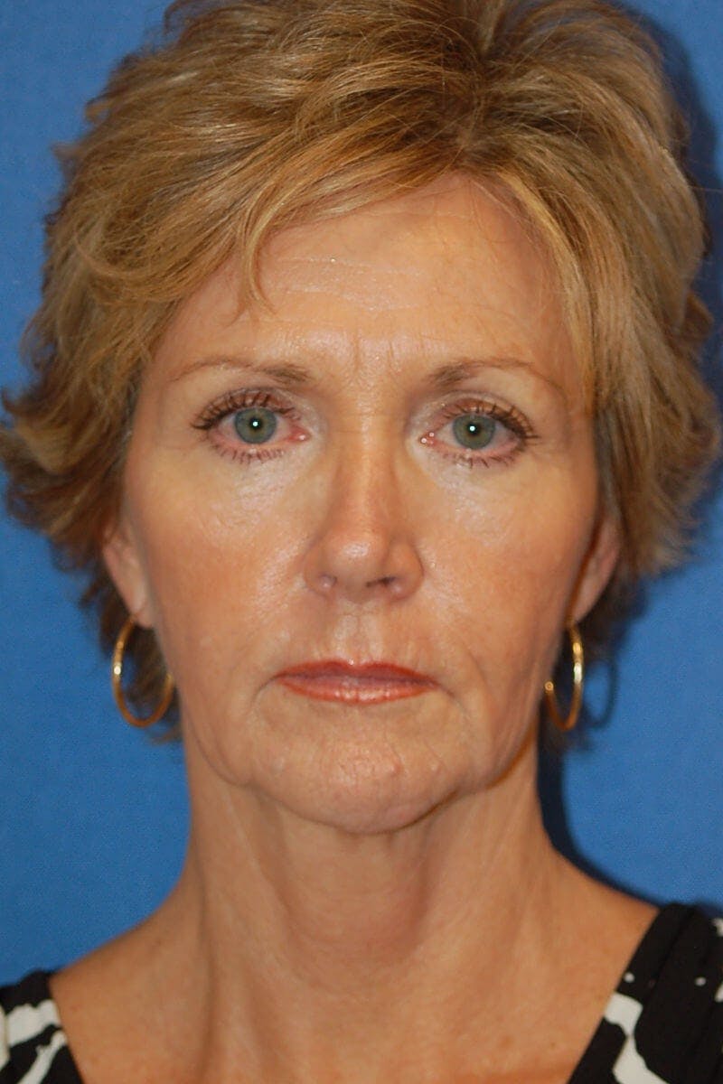 Face Lift Before & After Gallery - Patient 91514721 - Image 1