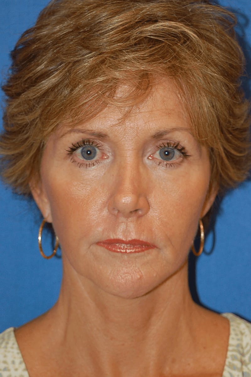 Face Lift Before & After Gallery - Patient 91514721 - Image 2