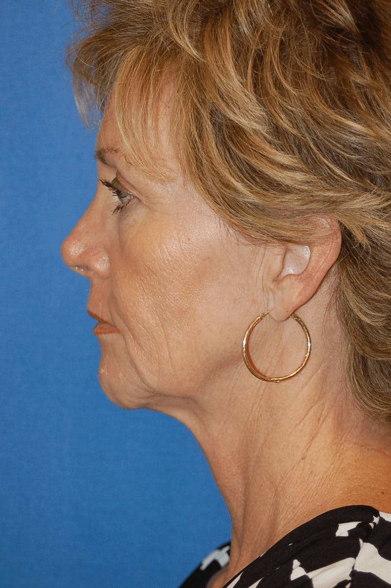 Face Lift Before & After Gallery - Patient 91514721 - Image 5