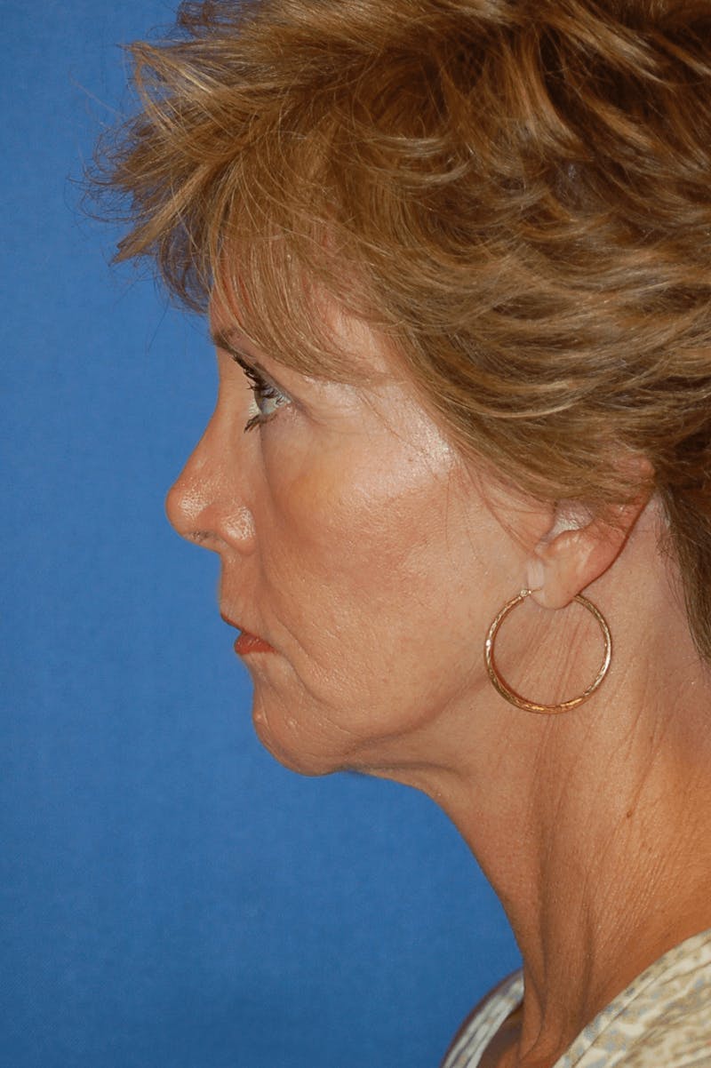 Face Lift Before & After Gallery - Patient 91514721 - Image 6