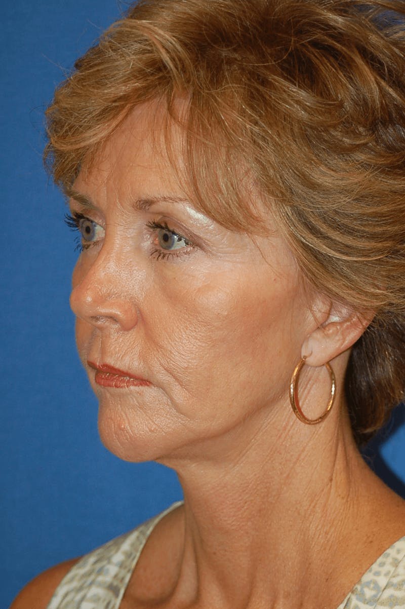 Face Lift Before & After Gallery - Patient 91514721 - Image 6