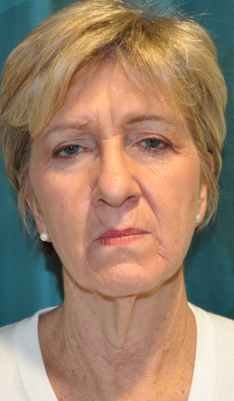 Face Lift Before & After Gallery - Patient 91514726 - Image 1