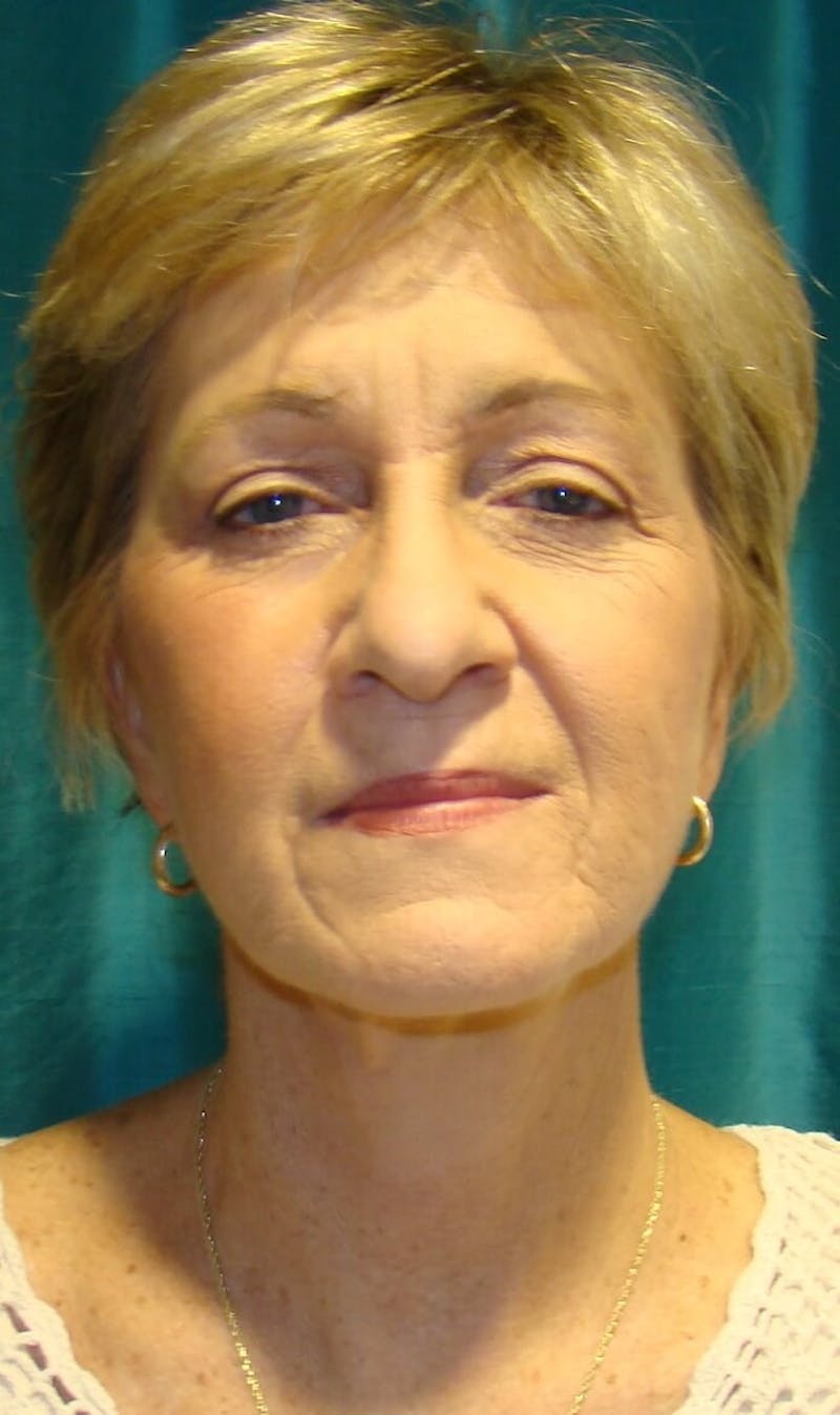 Face Lift Before & After Gallery - Patient 91514726 - Image 2