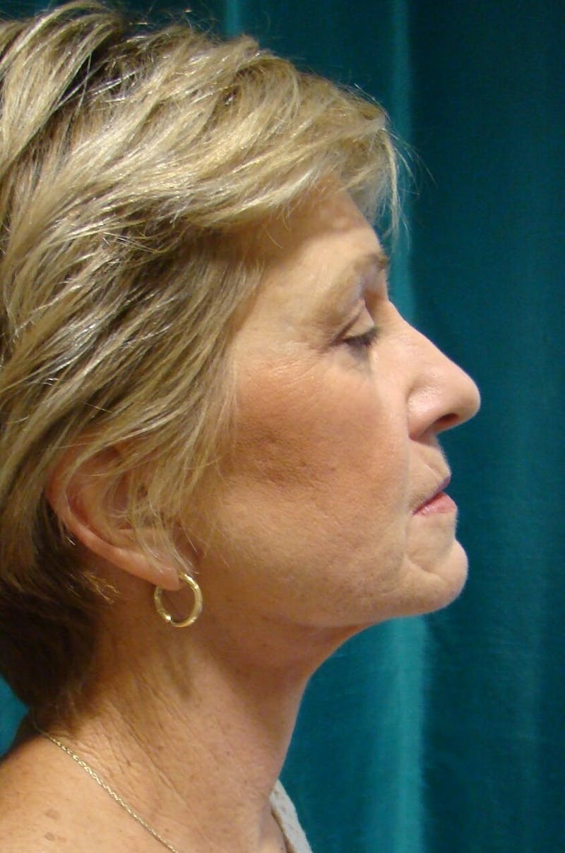 Face Lift Before & After Gallery - Patient 91514726 - Image 6