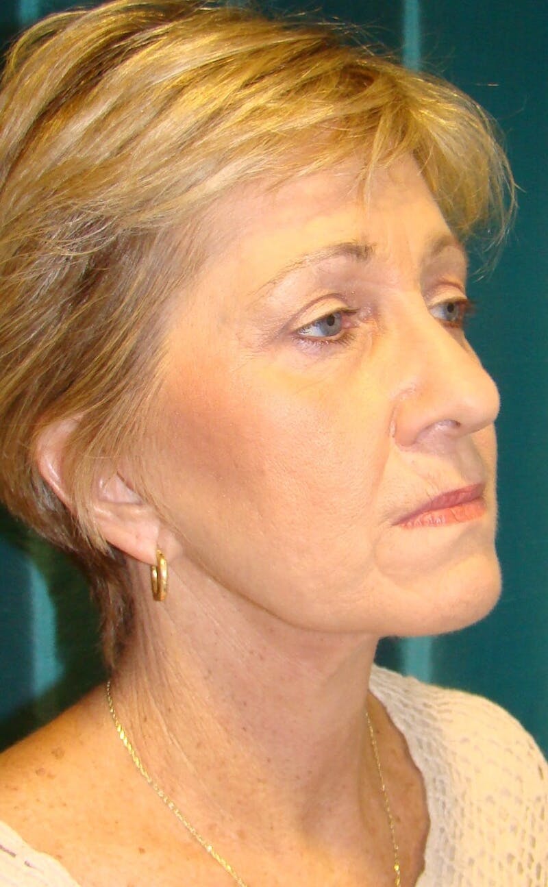 Face Lift Before & After Gallery - Patient 91514726 - Image 4