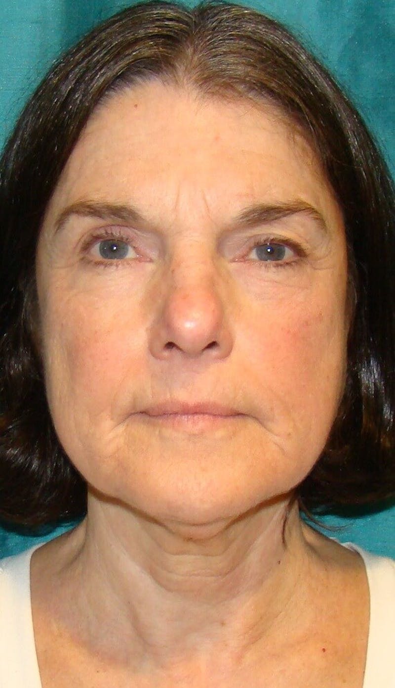 Face Lift Before & After Gallery - Patient 91514727 - Image 1