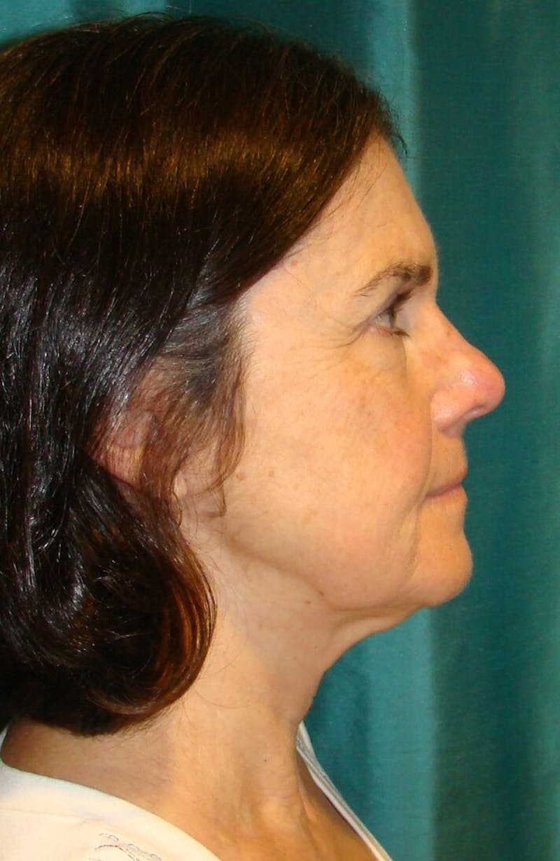 Face Lift Before & After Gallery - Patient 91514727 - Image 5