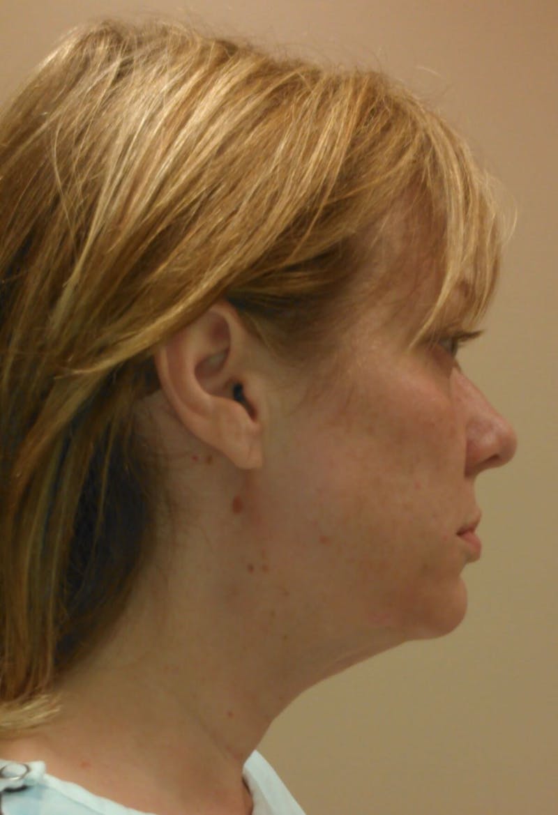 Face Lift Before & After Gallery - Patient 91514732 - Image 3