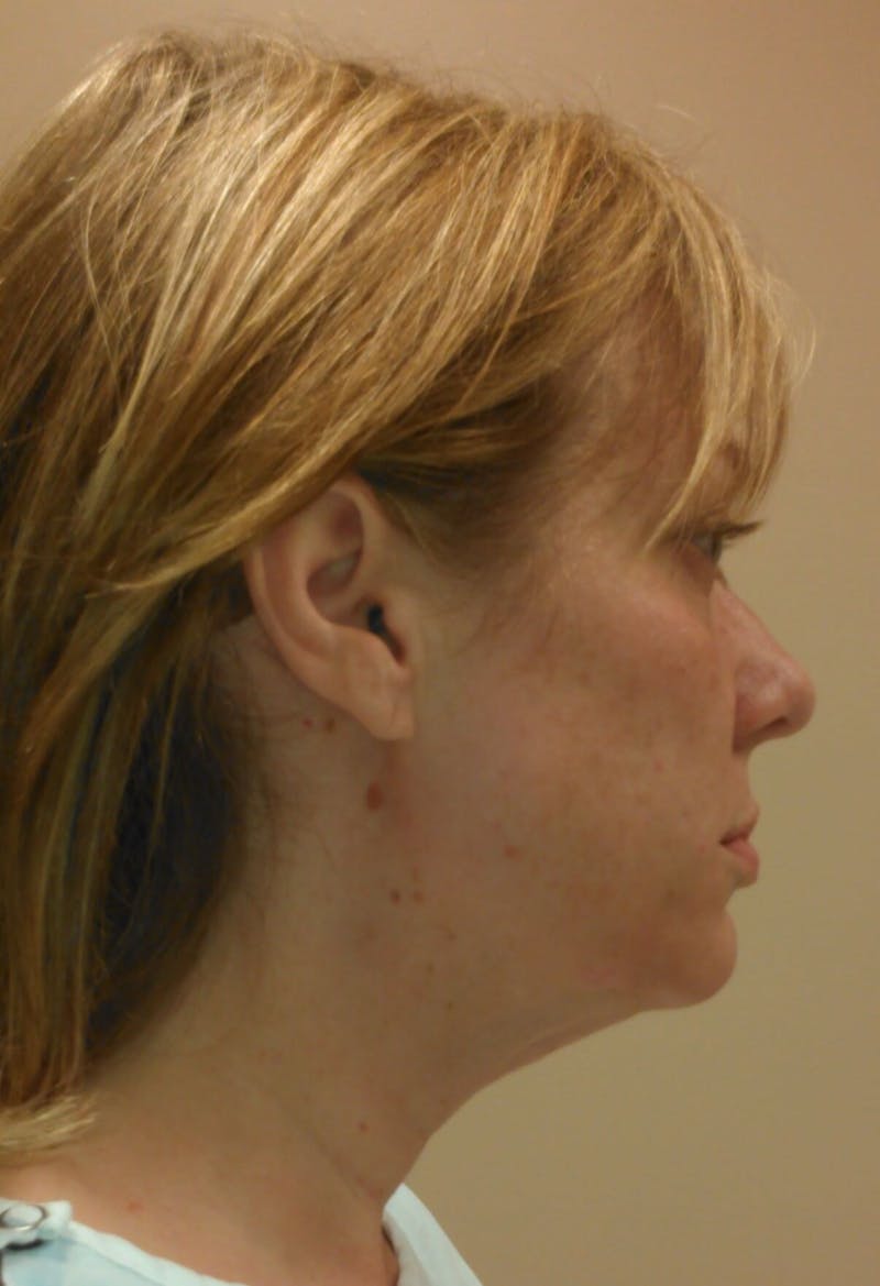 Face Lift Before & After Gallery - Patient 91514732 - Image 5