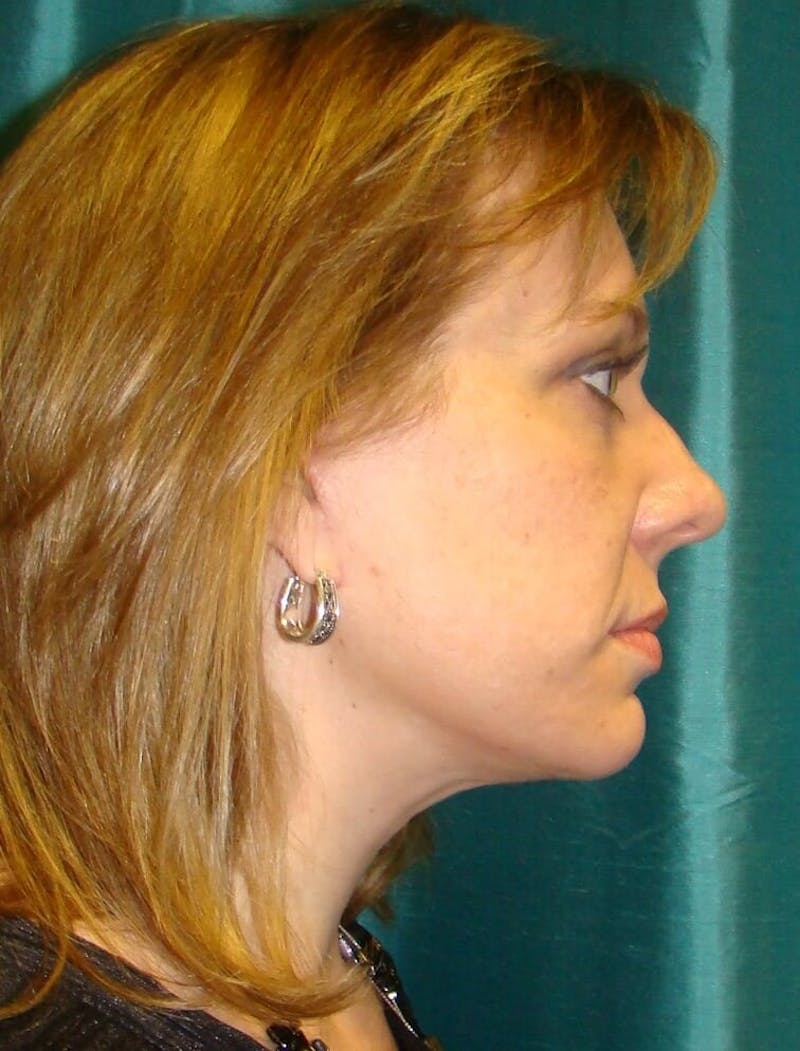 Face Lift Before & After Gallery - Patient 91514732 - Image 6