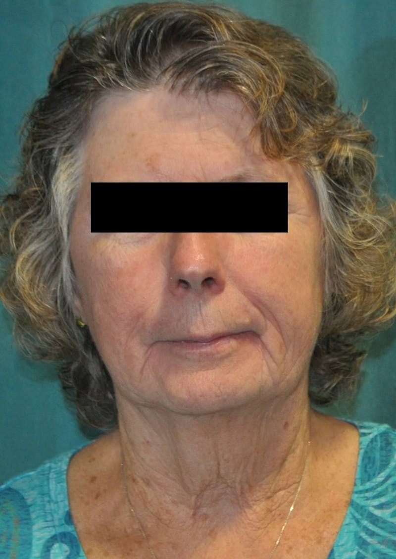 Face Lift Before & After Gallery - Patient 91514733 - Image 1