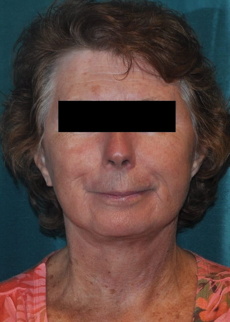 Face Lift Before & After Gallery - Patient 91514733 - Image 2