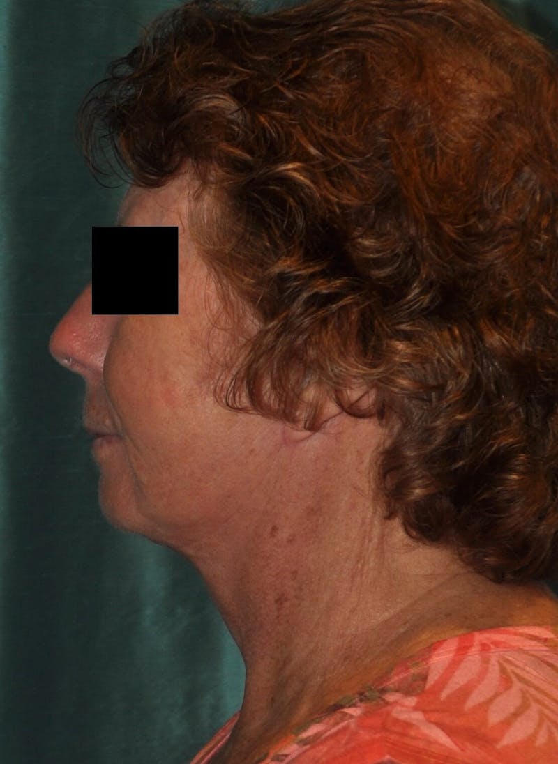 Face Lift Before & After Gallery - Patient 91514733 - Image 4