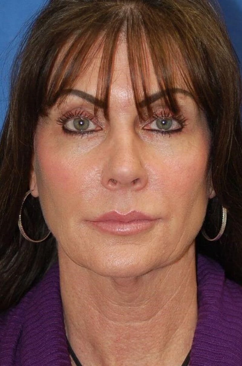 Face Lift Before & After Gallery - Patient 91514737 - Image 1