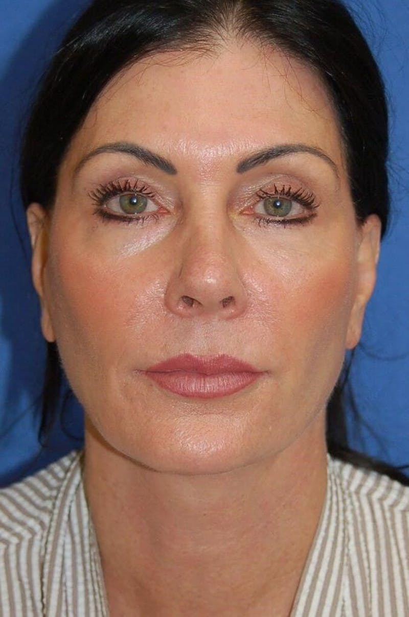 Face Lift Before & After Gallery - Patient 91514737 - Image 2