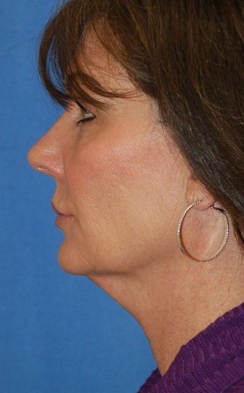 Face Lift Before & After Gallery - Patient 91514737 - Image 5