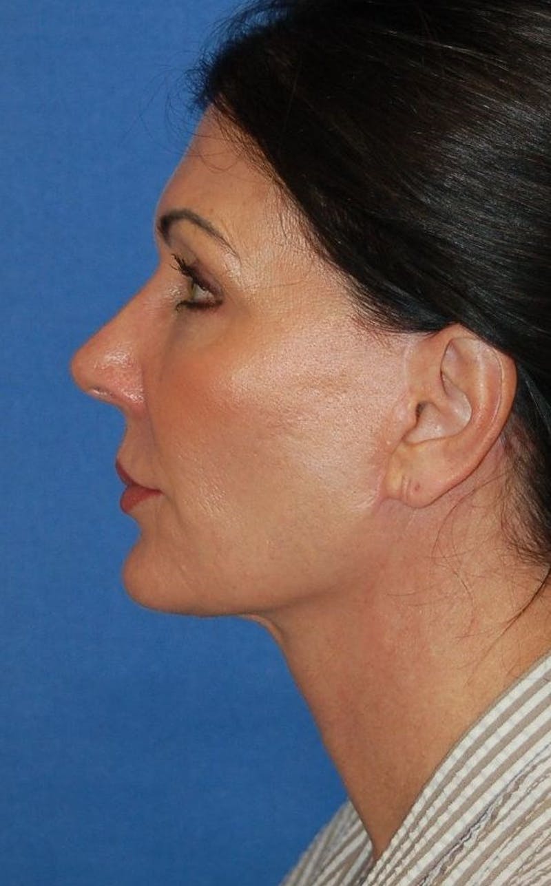 Face Lift Before & After Gallery - Patient 91514737 - Image 4