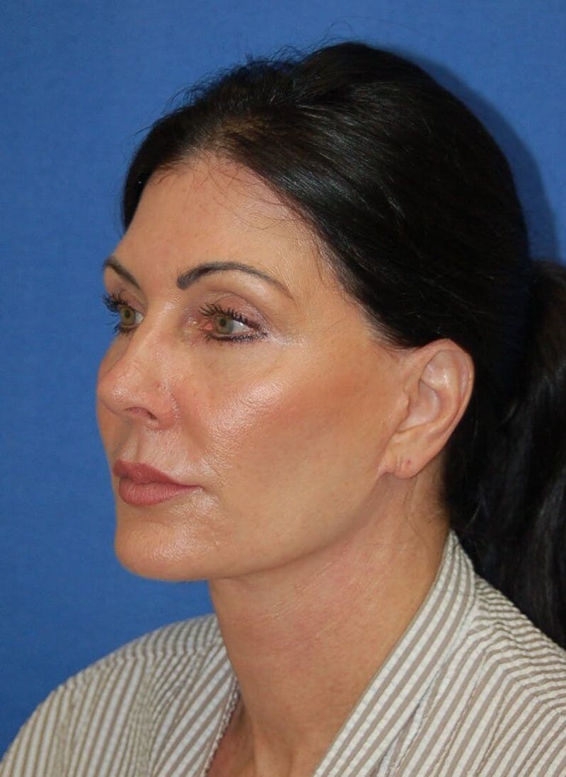 Face Lift Before & After Gallery - Patient 91514737 - Image 4