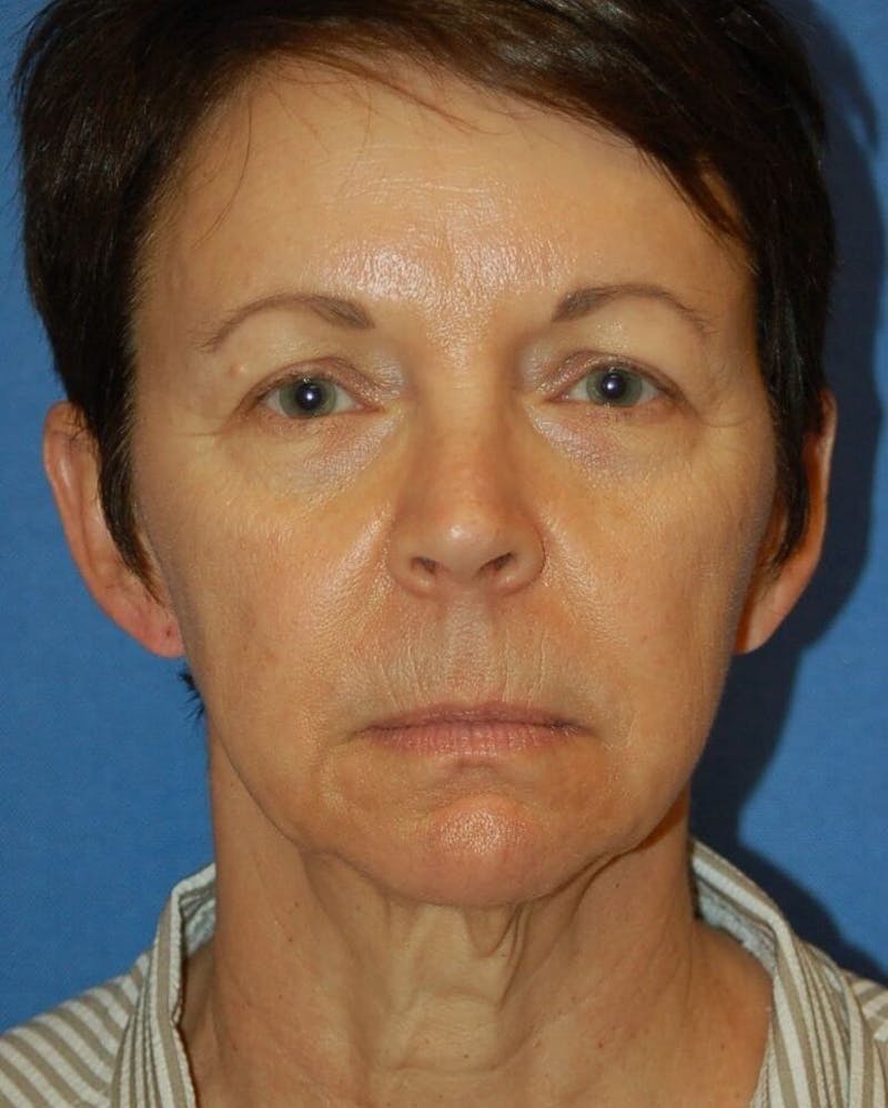 Face Lift Before & After Gallery - Patient 91514741 - Image 1