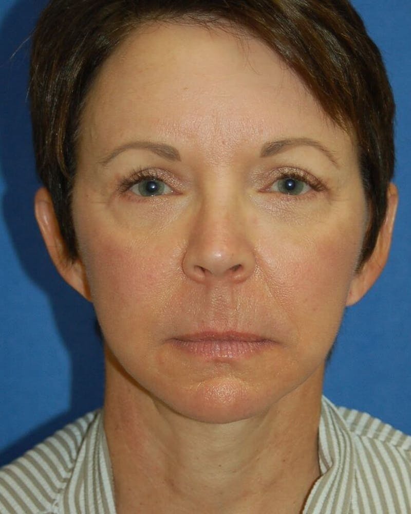 Face Lift Before & After Gallery - Patient 91514741 - Image 2