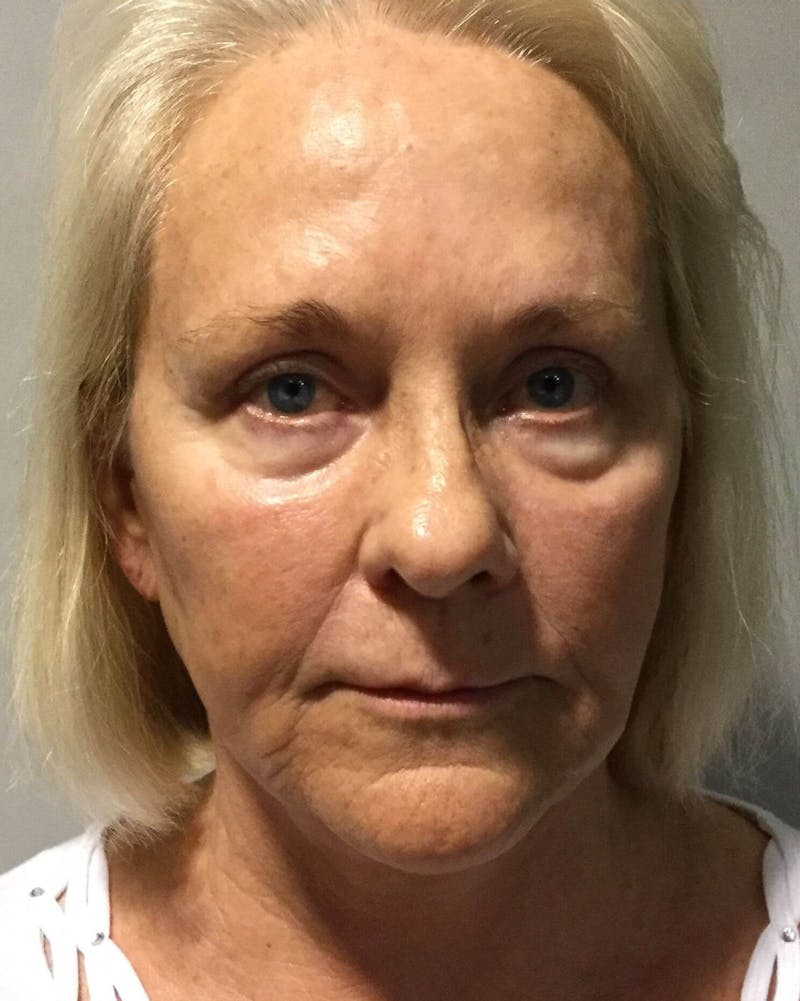 Face Lift Before & After Gallery - Patient 91514745 - Image 2