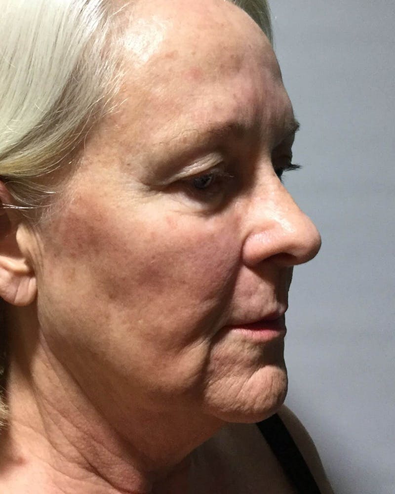 Face Lift Before & After Gallery - Patient 91514745 - Image 3