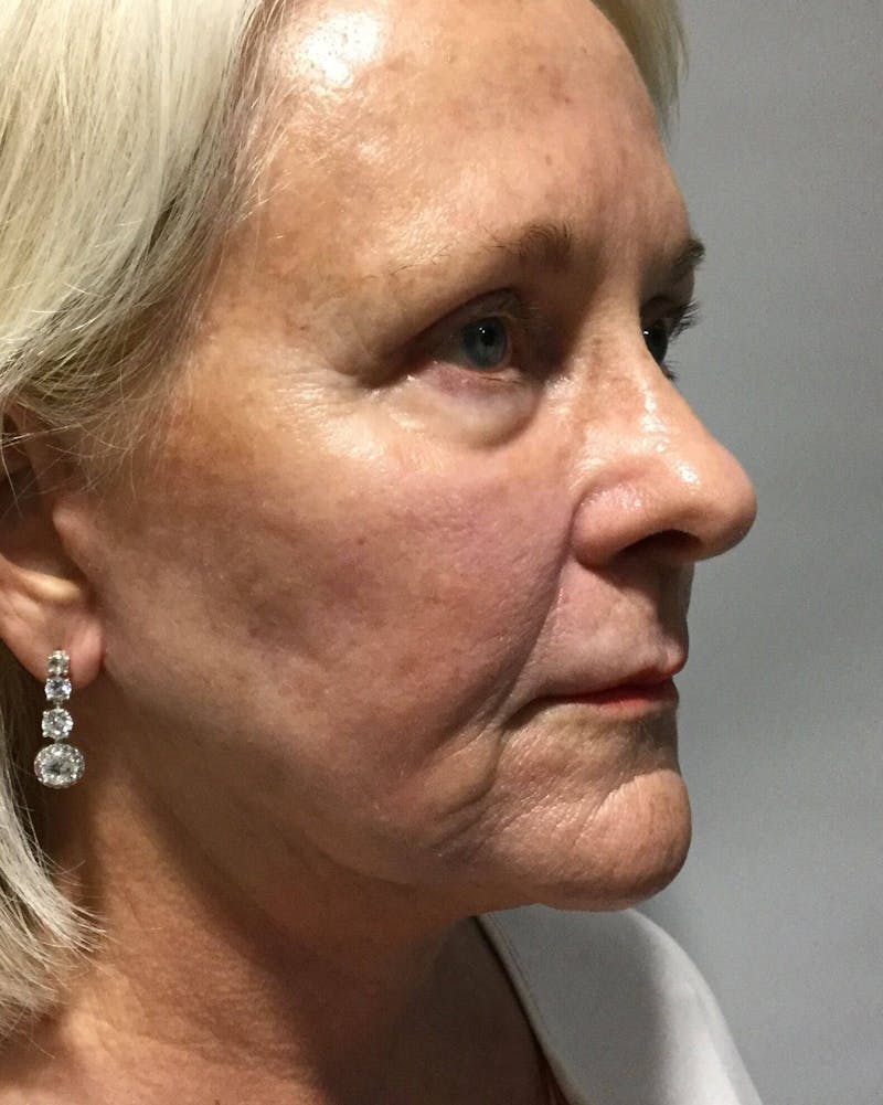Face Lift Before & After Gallery - Patient 91514745 - Image 4