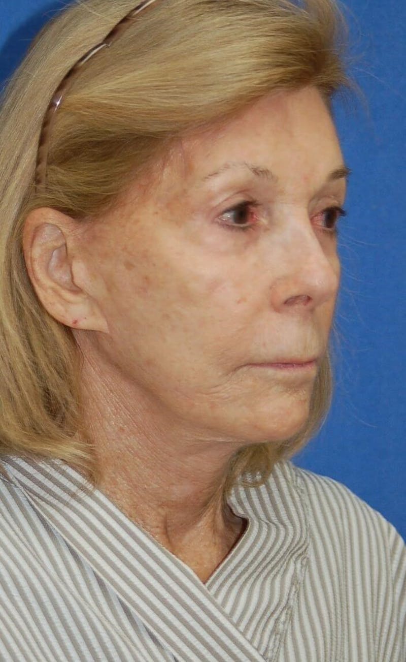 Face Lift Before & After Gallery - Patient 91514748 - Image 4