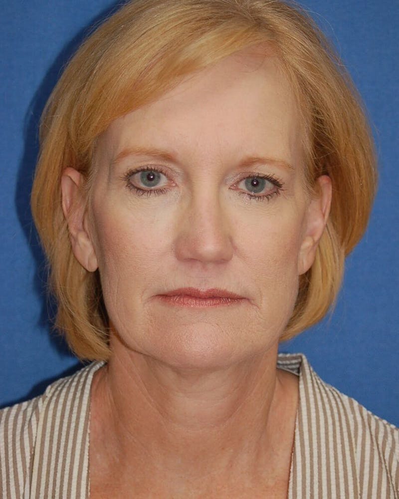 Face Lift Before & After Gallery - Patient 91514752 - Image 1