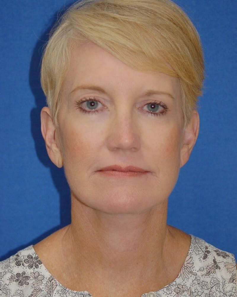 Face Lift Before & After Gallery - Patient 91514752 - Image 2
