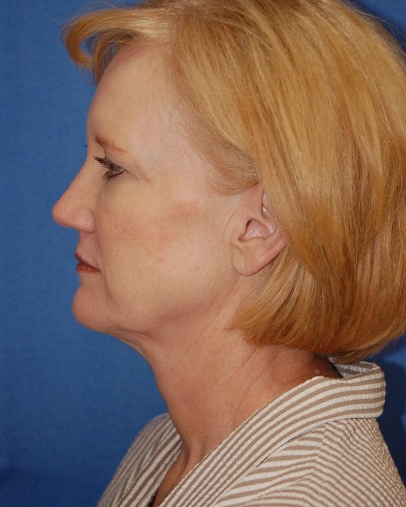 Face Lift Before & After Gallery - Patient 91514752 - Image 5