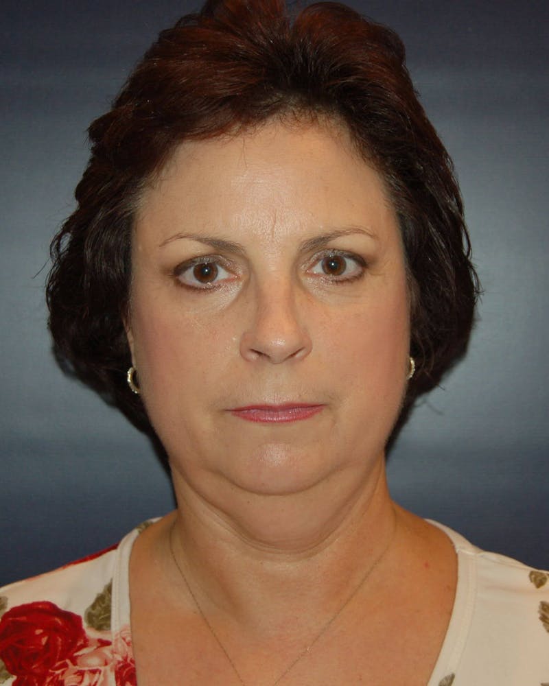 Face Lift Before & After Gallery - Patient 91514756 - Image 1
