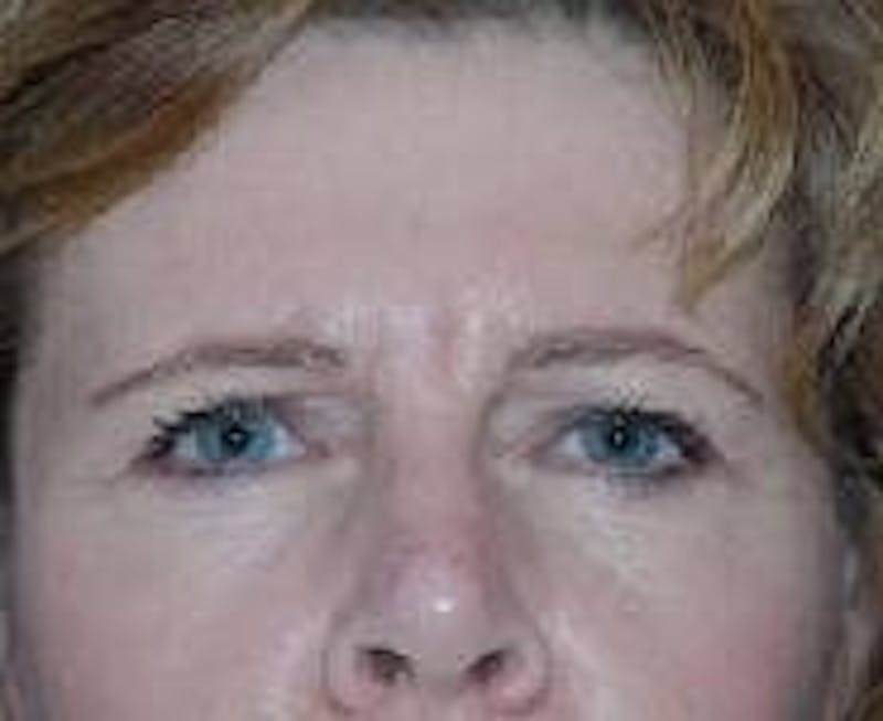 Brow Lift Before & After Gallery - Patient 91514785 - Image 5