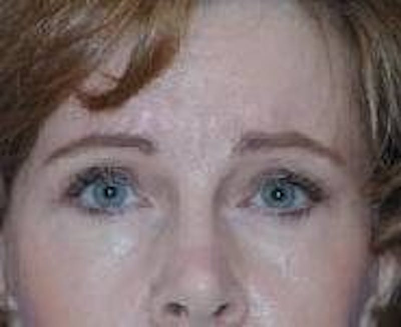 Brow Lift Before & After Gallery - Patient 91514785 - Image 6