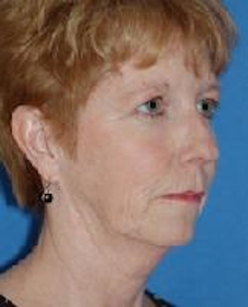 Brow Lift Before & After Gallery - Patient 91514791 - Image 3
