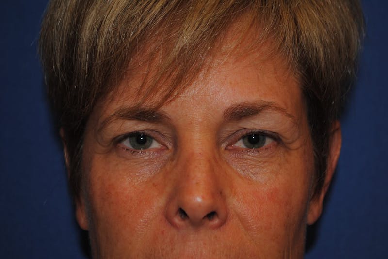 Brow Lift Before & After Gallery - Patient 91514796 - Image 1