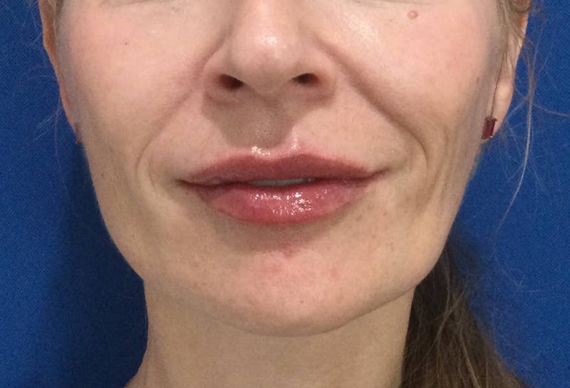 Restylane® Before & After Gallery - Patient 117927610 - Image 2