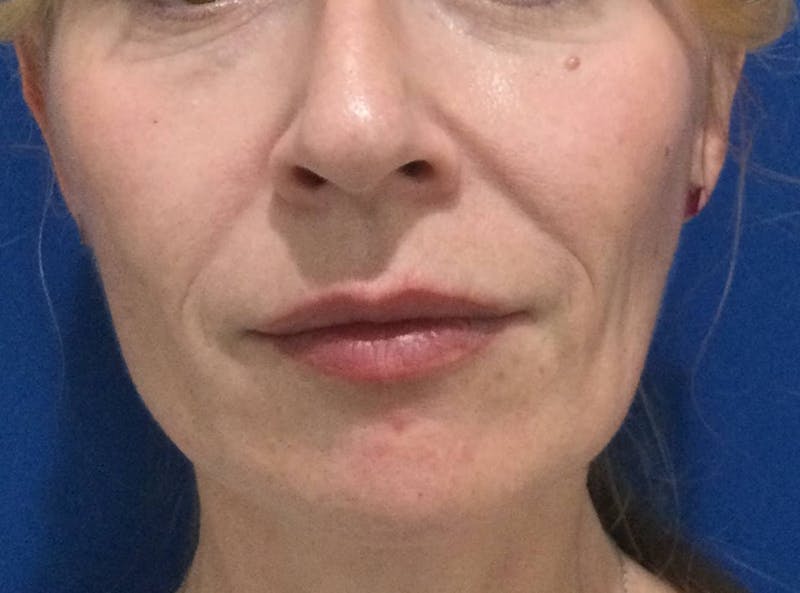 Restylane® Before & After Gallery - Patient 117927610 - Image 1