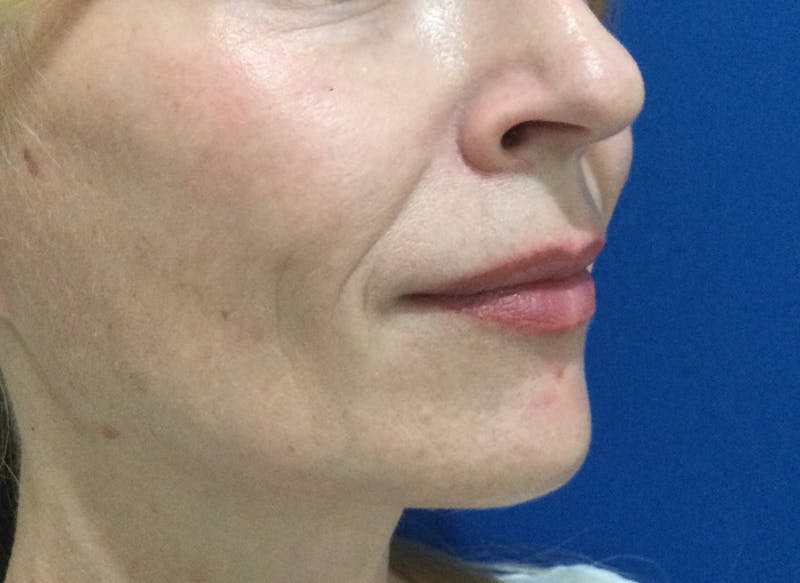 Restylane® Before & After Gallery - Patient 117927610 - Image 3