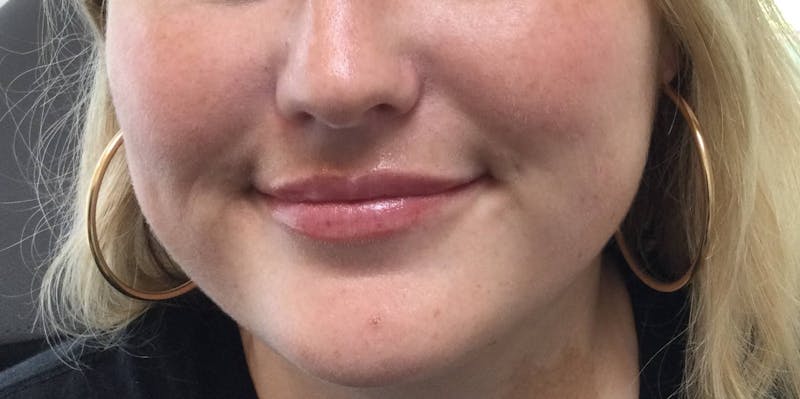 Restylane® Before & After Gallery - Patient 117927612 - Image 2