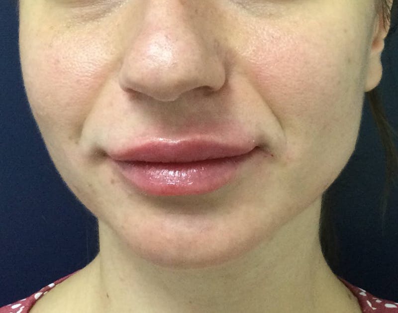 Restylane® Before & After Gallery - Patient 117927613 - Image 2