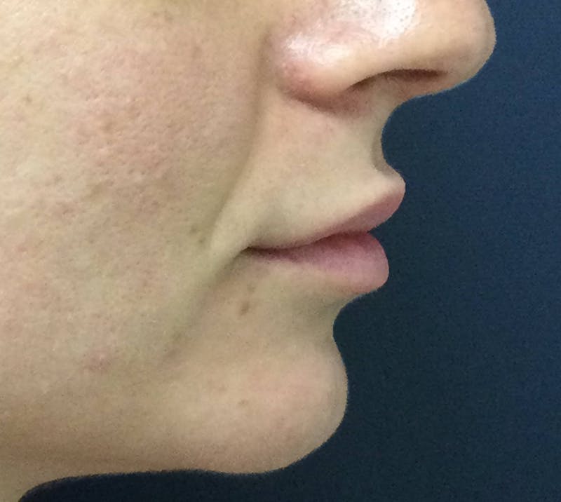 Restylane® Before & After Gallery - Patient 117927613 - Image 3