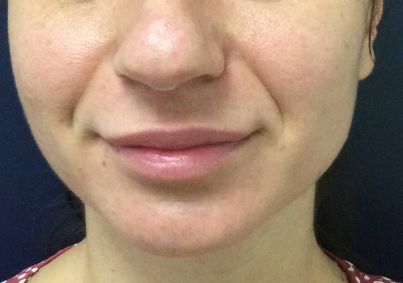 Restylane® Before & After Gallery - Patient 117927613 - Image 1