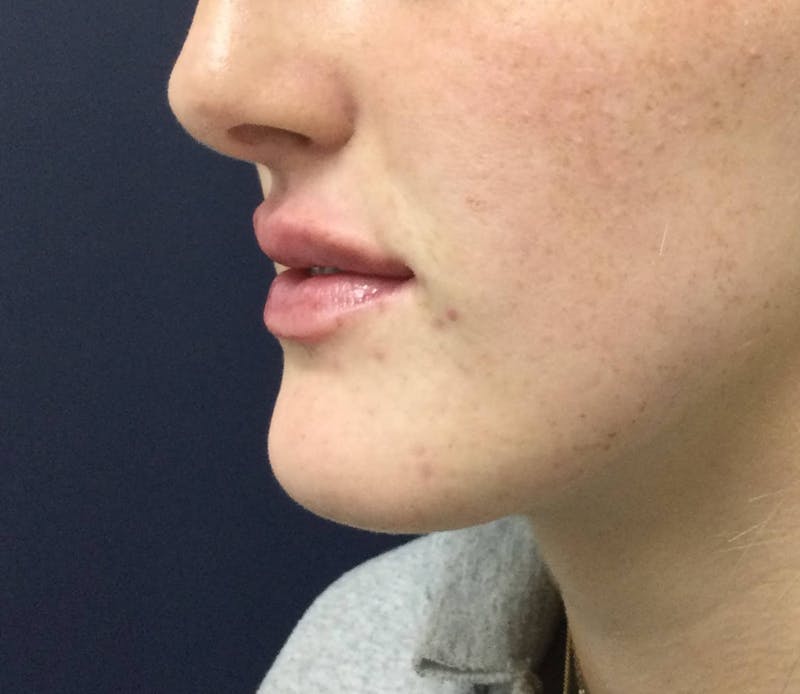 Restylane® Before & After Gallery - Patient 117927614 - Image 4