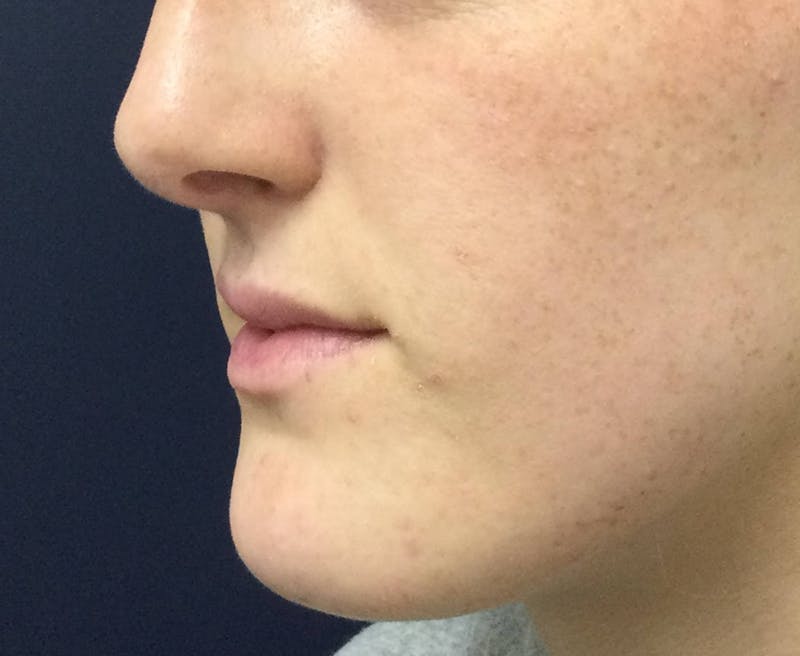 Restylane® Before & After Gallery - Patient 117927614 - Image 3