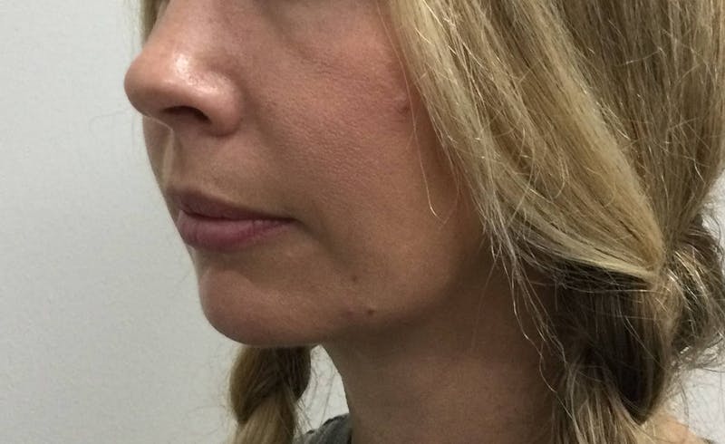 Restylane® Before & After Gallery - Patient 117927872 - Image 1