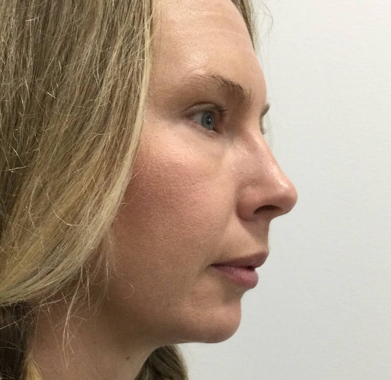 Restylane® Before & After Gallery - Patient 117927872 - Image 3