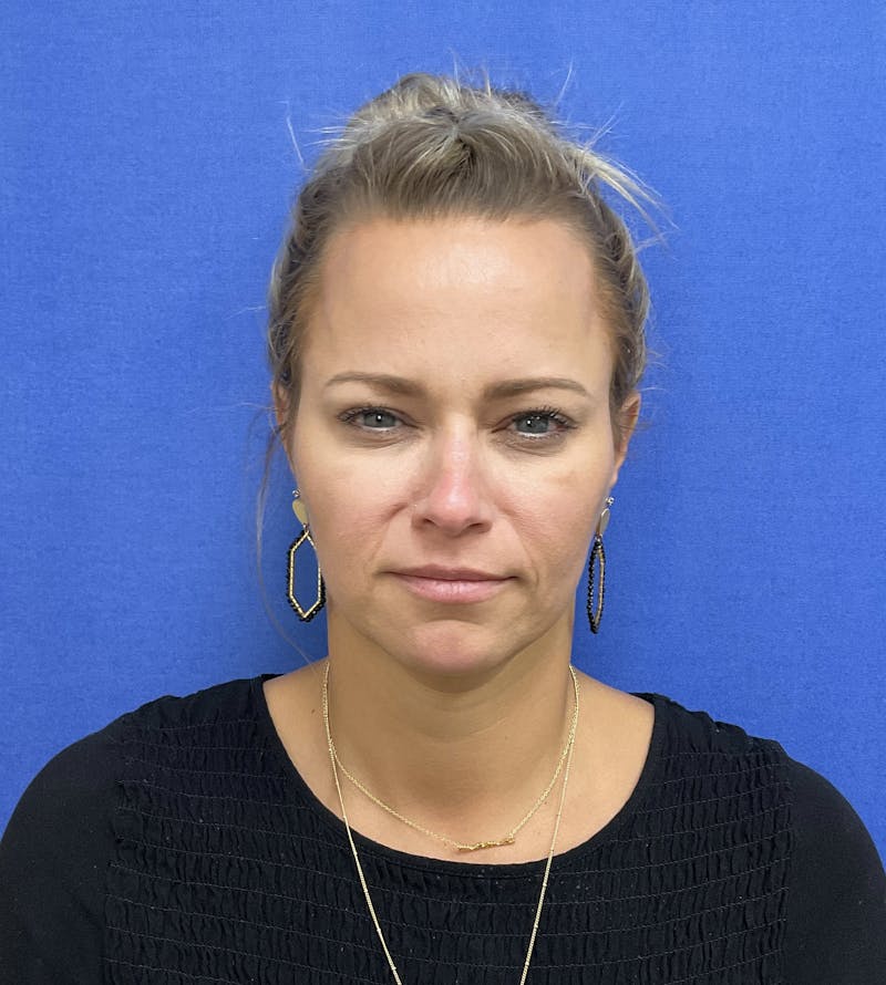 BOTOX® Before & After Gallery - Patient 146222245 - Image 2